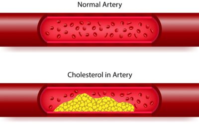 Turmeric, Curcumin and LDL Cholesterol: Natural Ways to Lower Oxidative Stress