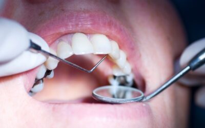Safe Removal of Mercury Amalgam Fillings