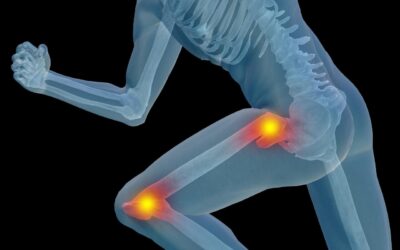 Functional Medicine Treatments to Diagnose, Prevent and Reverse Osteoporosis Naturally
