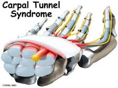 Have You Tried Everything to Get Rid of Carpal Tunnel Syndrome?