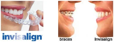 Invisalign Clear Braces to Straighten Your Teeth
